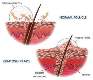 A diagram of Keratosis Pilaris